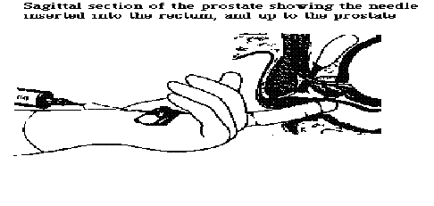 prostate.gif